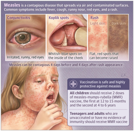 Measles is a contagious disease that spreads via air and contaminated surfaces. Common symptoms include fever, cough, runny nose, red eyes and a rash. Conjunctivitis - irritated, runny, red eyes. Koplik spots - whitish-blue spots on the inside of the cheek. Rash - flat, red spots that can become raised. Measles can be contagious 4 days before and 4 days after rash appearance. Vaccination is safe and highly protective against measles. All children: should receive 2 doses of measles-mumps-rubella (MMR) vaccine, the first at 12 to 15 months and the second at 4 to 6 years. Teenagers and adults who are unvaccinated or have no evidence of immunity should receive MMR vaccine.